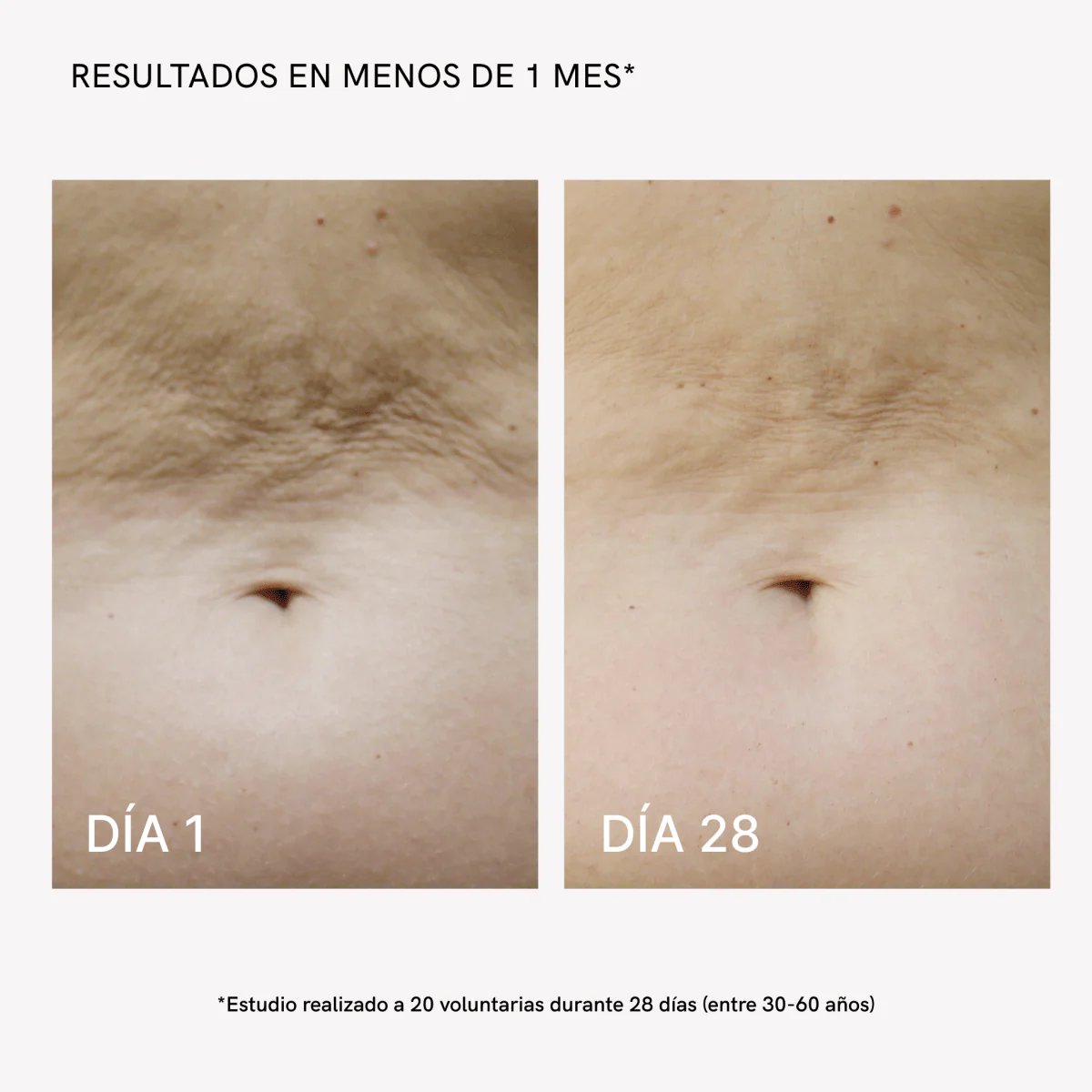 RF Tratamiento Flacidez Corporal - Image 4