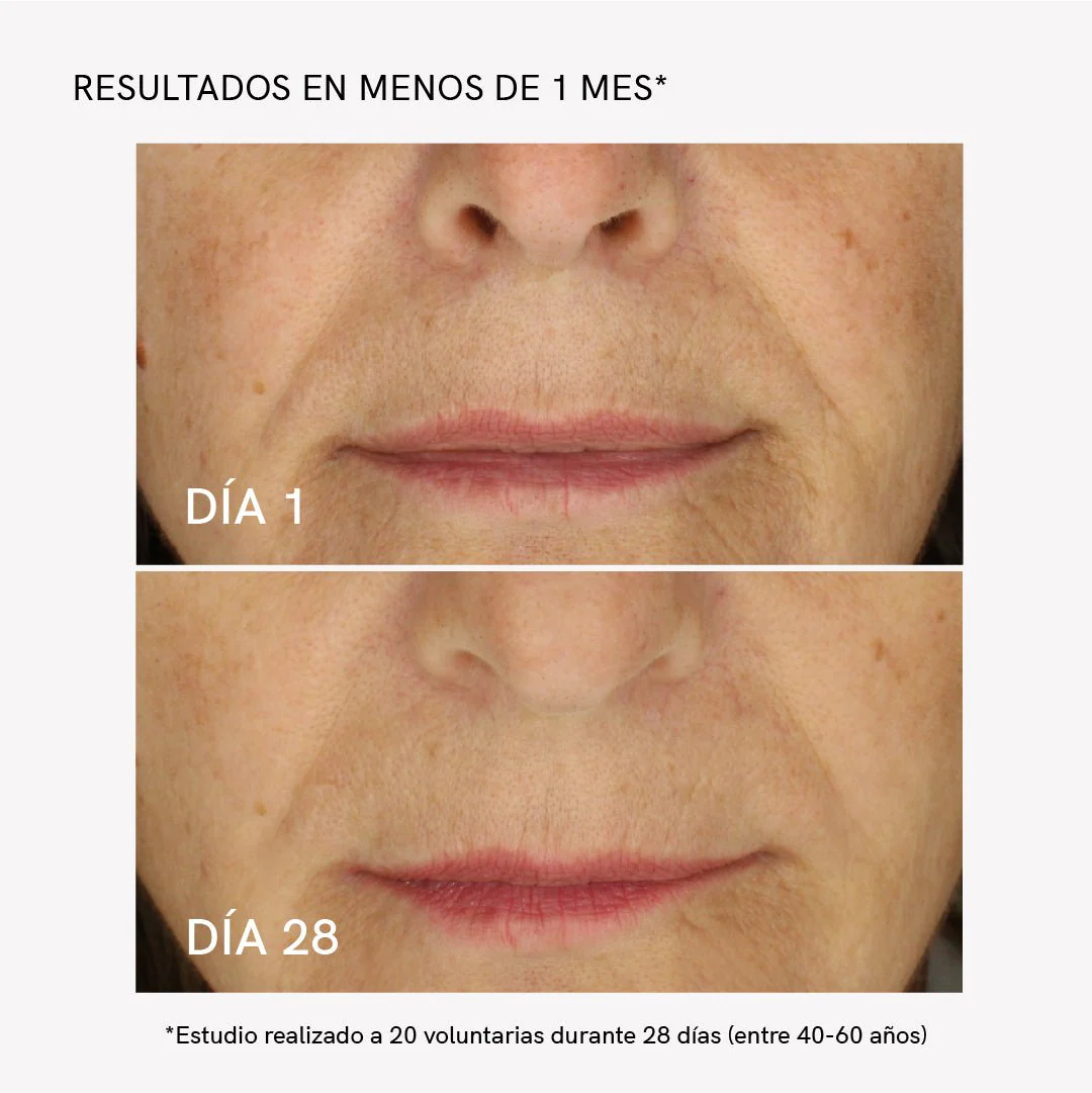 RF Tratamiento Flacidez Facial - Image 4
