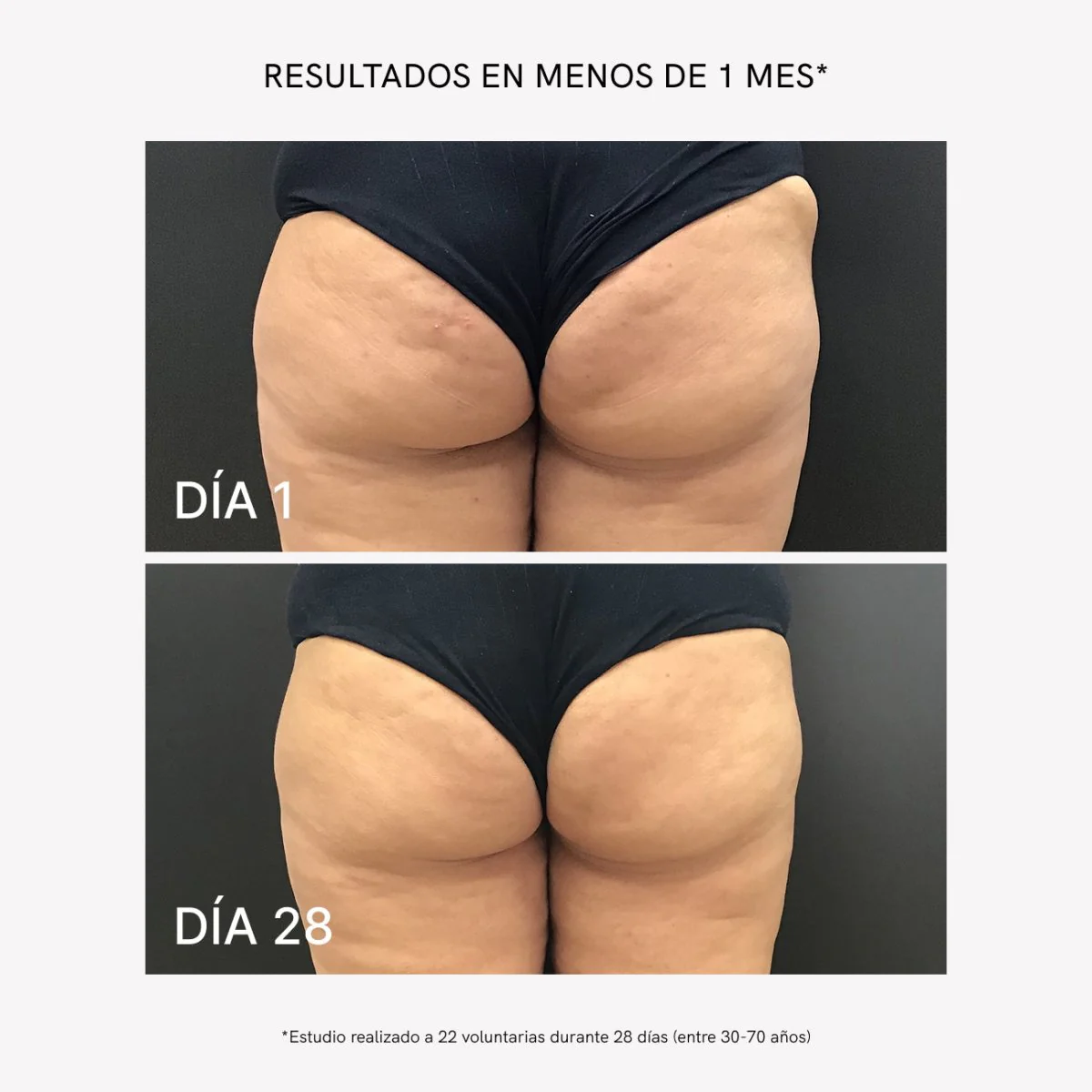 Tratamiento Lipoventosa Anticelulítico - Image 4